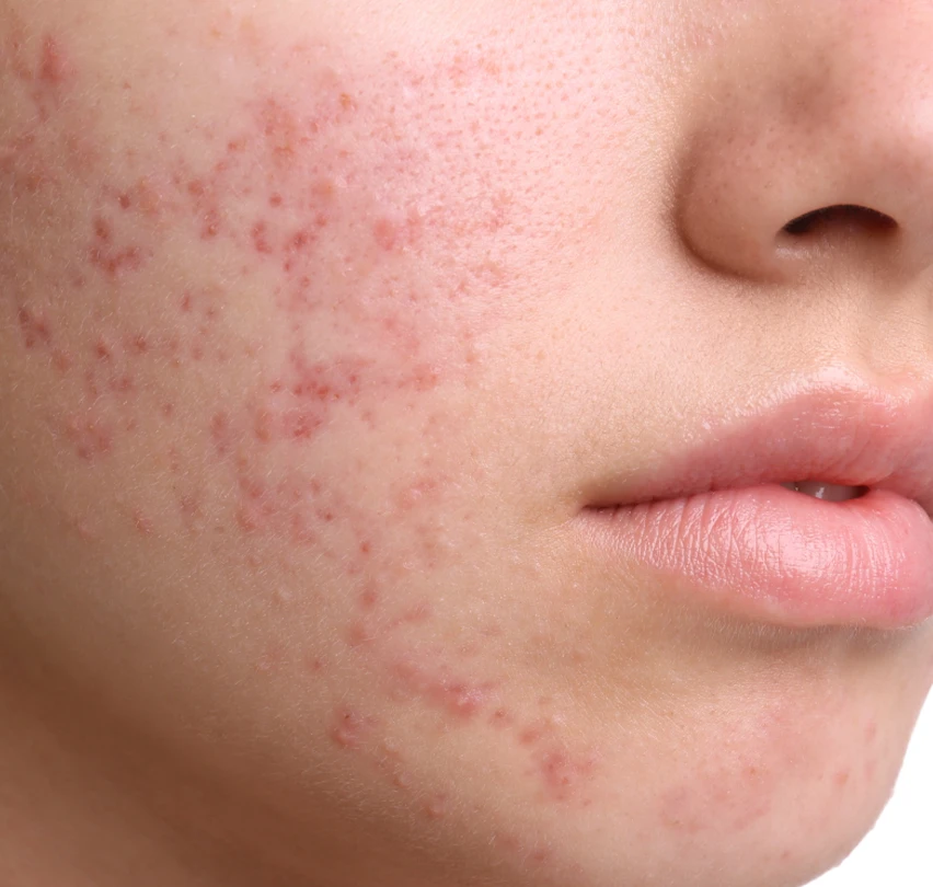 Acne Scars: Get Clear Skin With Our Acne Scar Specialist in Virginia